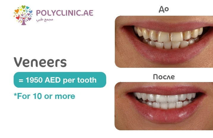 Perfect Your Smile with Veneers