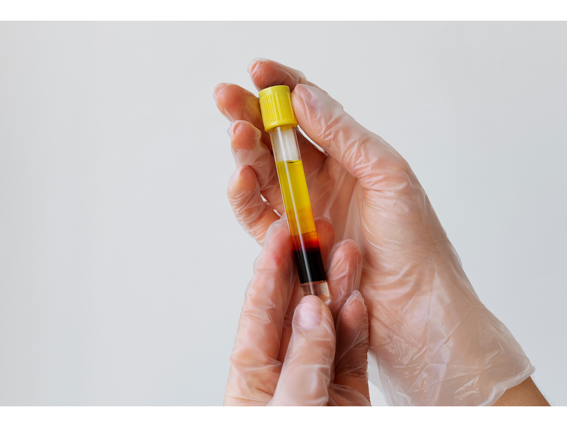 PRP Therapy (Platelet-Rich Plasma)