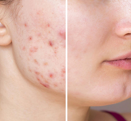 Acne and Post-Acne Treatment