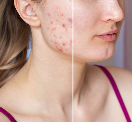 Лечение акне и постакне