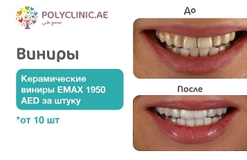 Виниры для безупречной улыбки